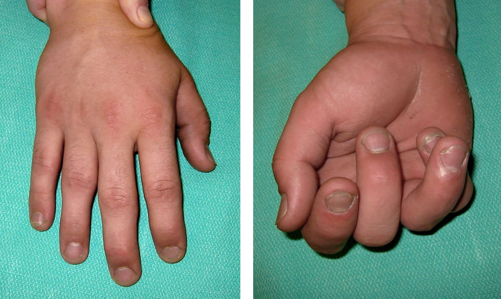 Dream Meaning of Crushed Someones Fingers