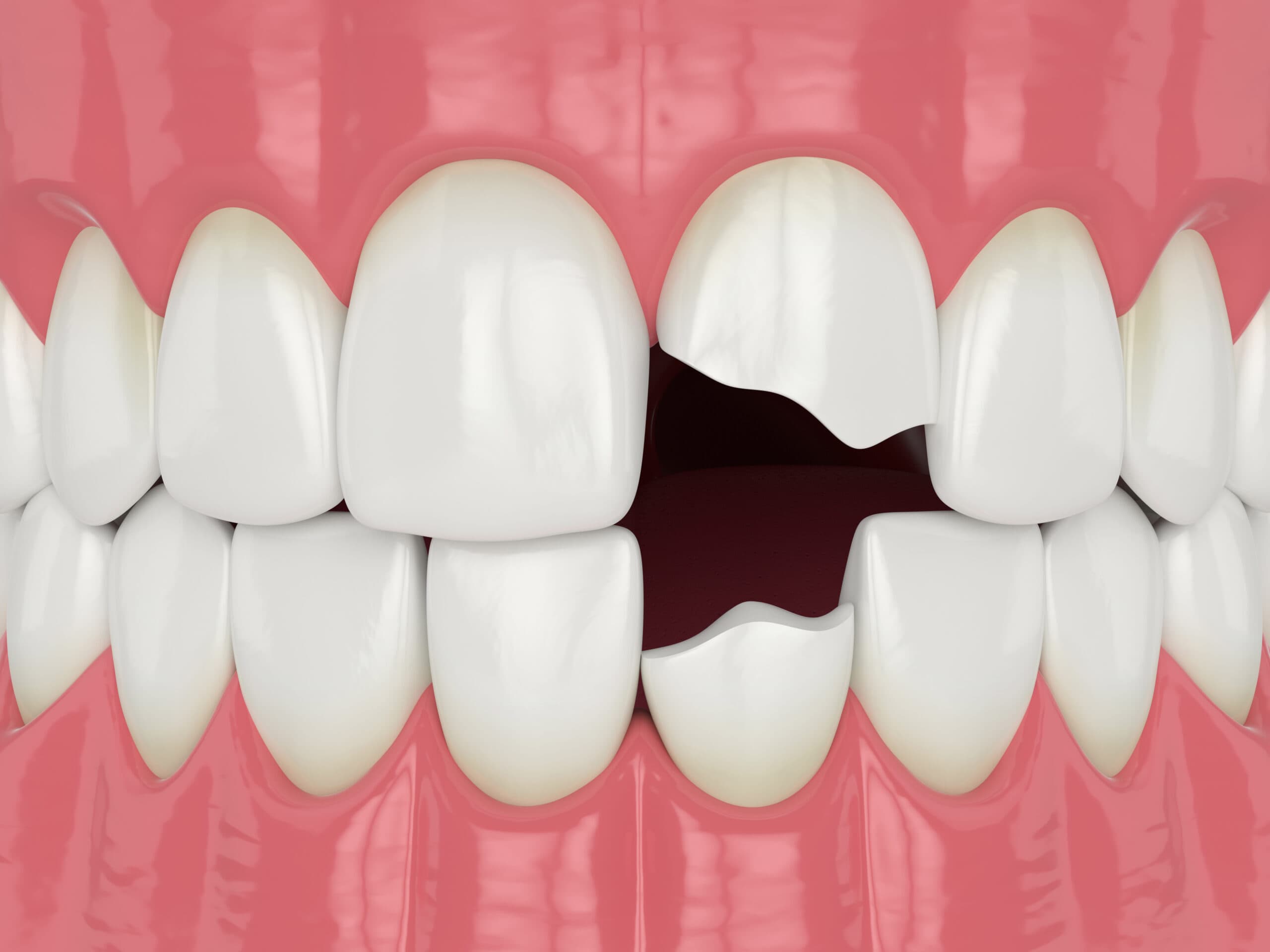 Dream Meaning of Broken Tooth