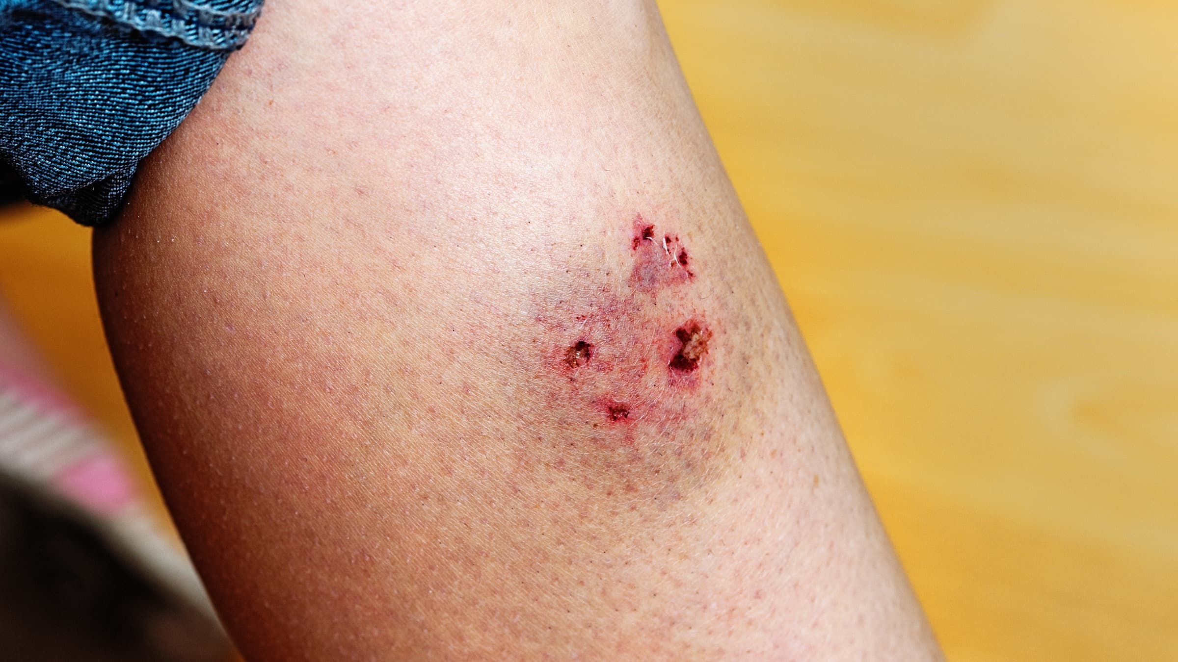 Dream Meaning of Dog Biting You