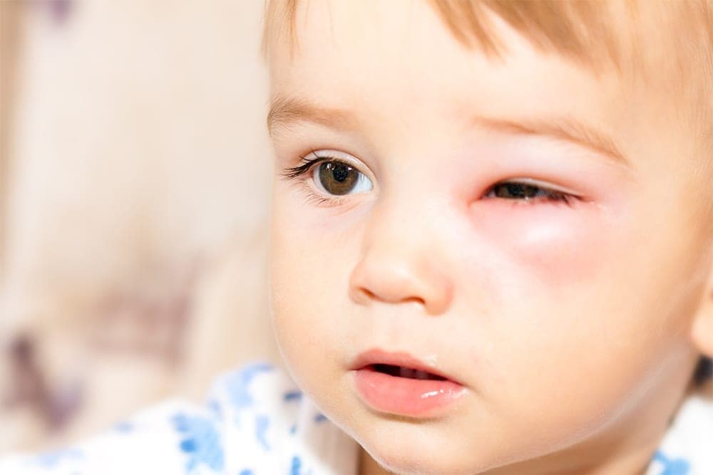 Dream Meaning of Bee Sting Face
