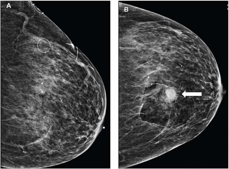 Dream Meaning of Bleeding Breast