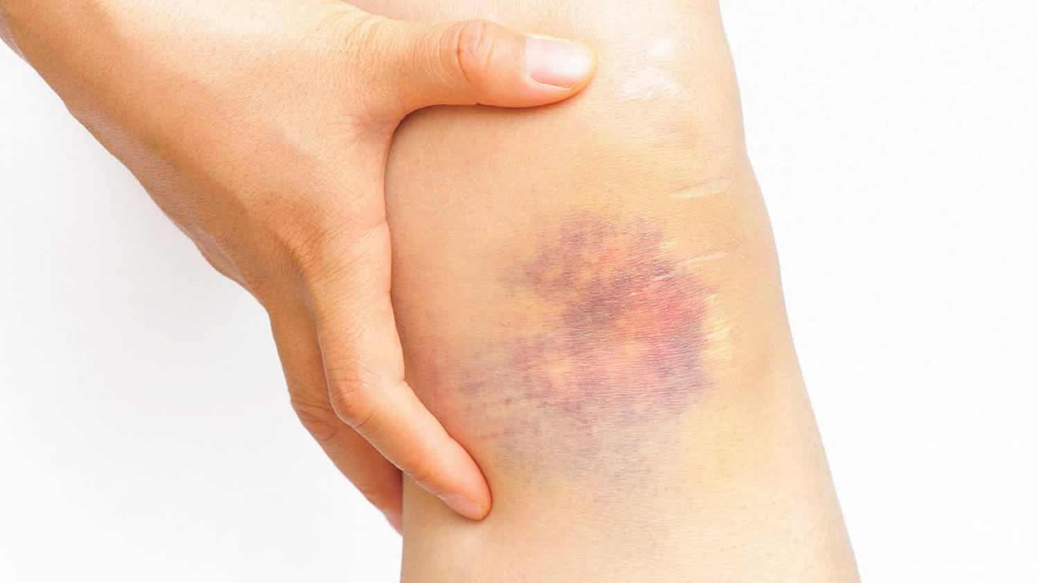 Dream Meaning of Bruised Leg