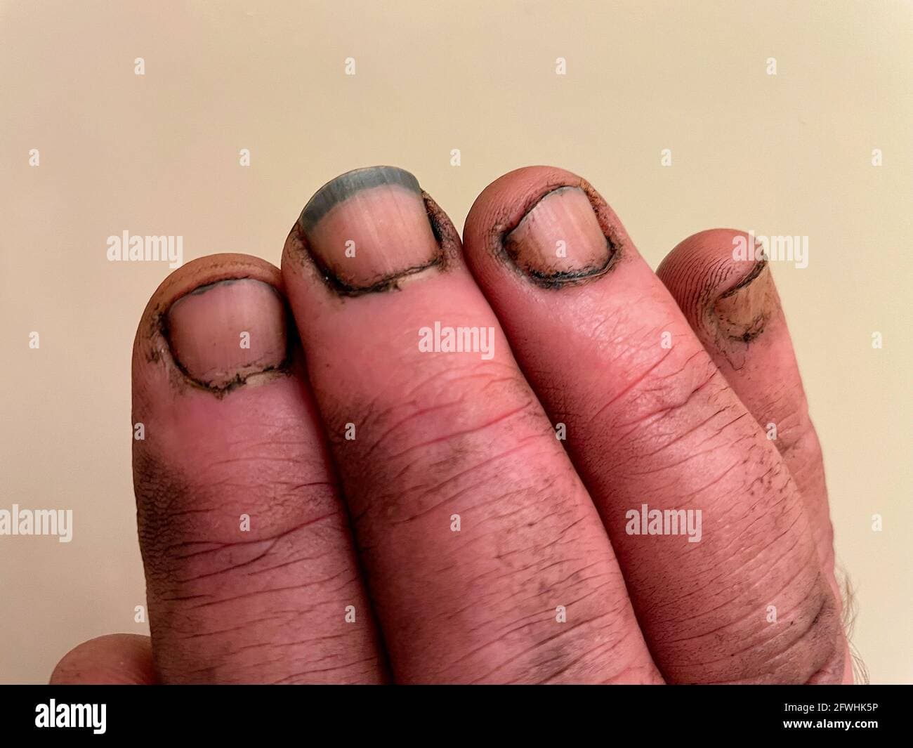 Dream Meaning of Dirty Fingernails
