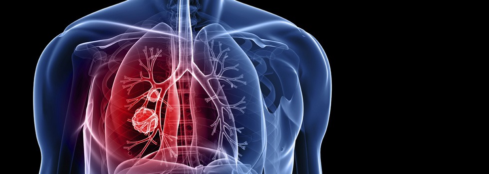 Mild Emphysema and Low-Dose Lung Screening: When to Get Checked