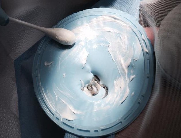 Why Should a Dental Dam Be Non-Latex Allergy and Safety Concerns