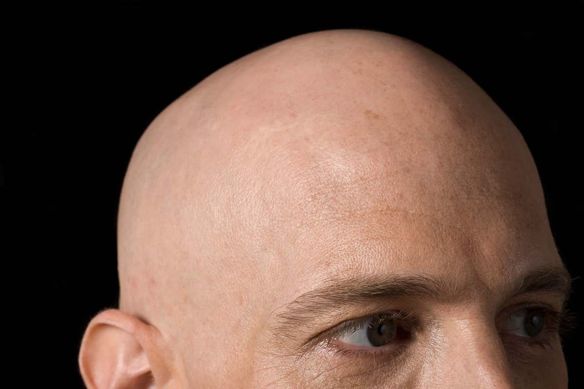 Dream Meaning of Being Bald