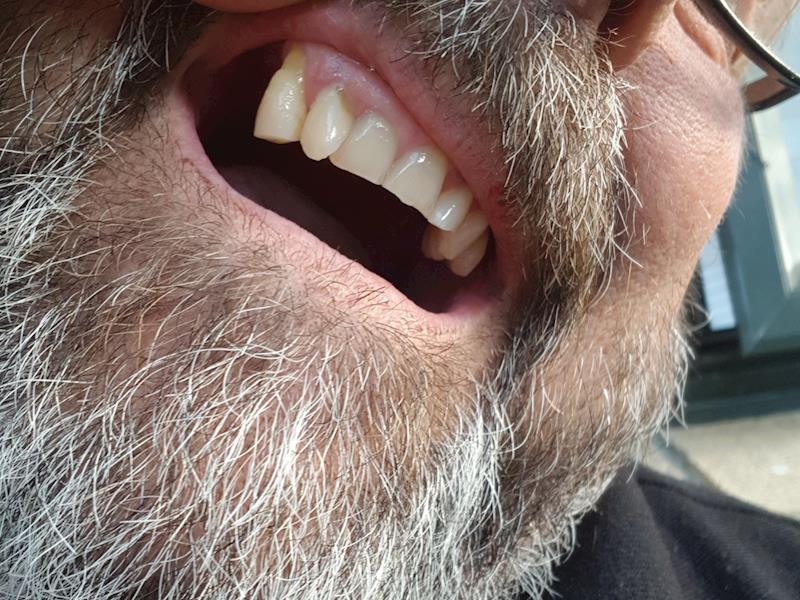 Dream Meaning of All My Teeth Falling Out