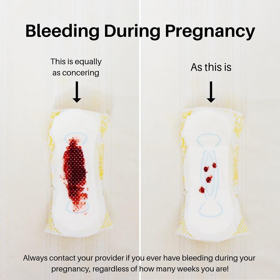 Dream Meaning of Bleeding During Pregnancy